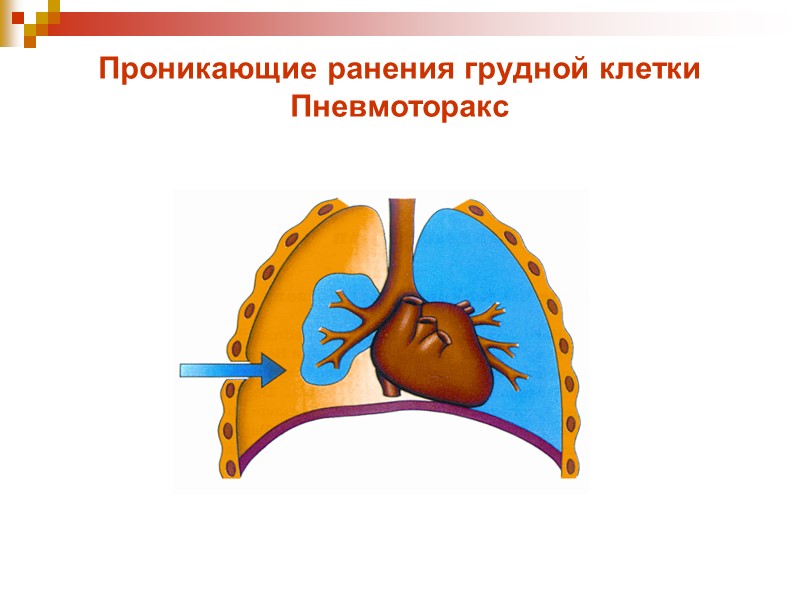 Проникающие ранения грудной клетки Пневмоторакс